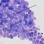 Figure 1b: Intermediate to large lymphocytes (500x, Wright's stain)