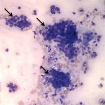 Figure 1b: Neoplastic epithelial cell clusters (Wright's stain, 200x)
