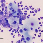 Figure 2: High power peritoneal fluid smear (Wright's stain)