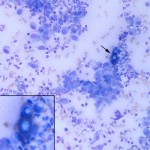 Figure 2: Blastomyces dermatitidis yeast (20x & 50x (inset), Wright's stain)