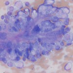 Figure 2a: High magnification (1000x) image of the adrenal mass aspirate (Wright's stain)