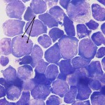 Figure 2b: Neoplastic lymphoblasts (1000x, Wright's stain)
