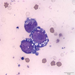 Figure 3: Pericardial fluid 1000x | eClinpath