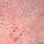 Figure 3: Histologic section of biopsied tissue (H&E stain).