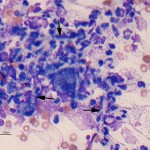 Figure 3: Fungal hyphae and non-degenerate neutrophils