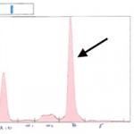 Figure 3a: Serum protein electrophoresis from the patient