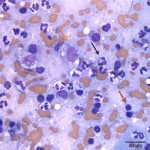 Figure 3b: Inflammatory cells (Wright's stain, 500x)