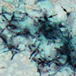 Figure 4: Fungal hyphae (GMS stain)