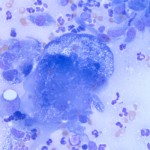Figure 4: Multinucleated macrophage with cytoplasmic vacuoles (50x, Wright's stain)