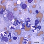 Figure 4: 1000x magnification of the area of the nasal mass shown in Figure 3 (Wright's stain)