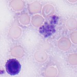 Figure 5: Lymphocyte and platelet aggregate (1000x, Wright's stain)