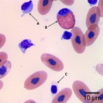 Figure 1a: Peripheral blood smear. (Wright's stain, 1000x)