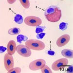 Figure 2a: Peripheral blood smear (Wright's stain, 1000x)