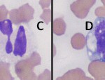 Figure 3: Leukocyte morphology and artifactual changes
