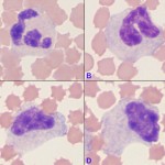Neutrophils precursors from the blood smear of a cow with severe inflammation.