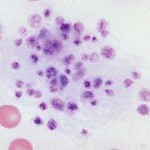 Platelet clump