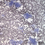 Figure 1. Peripheral blood smear. (Wright's stain, 20x objective)