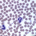 Figure 2: Blood smear (Wright’s stain, 100x).