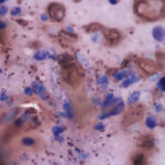 Figure 4. Left tarsus joint aspirate from a tortoise (Wright's stain 1000x)