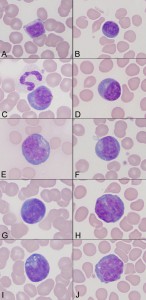 Reactive lymphocytes in an older dog with atrial hemangiosarcoma. 