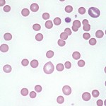 Spherocytes in a dog with IMHA
