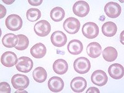 Target cells in liver disease | eClinpath