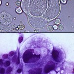 Unstained and stained neoplastic epithelial cells in urine