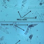 Waxy and granular casts in urine.