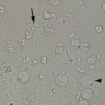 WBC and bacilli in unstained urine.