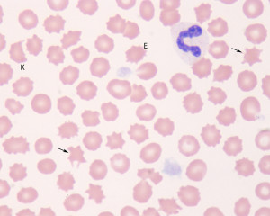 Acanthocytes
