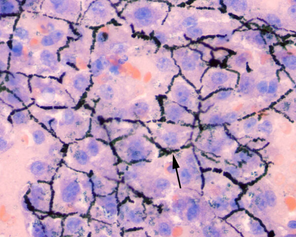 Bile casts