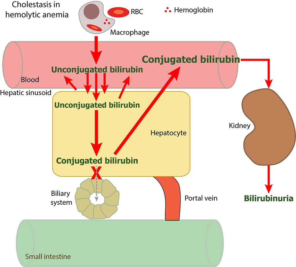 bilirubin-in-a-hemolytic-anemia-with-cholestasis-eclinpath