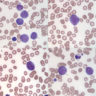 Blast versus promonocyte versus monocyte | eClinpath