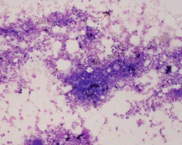 Normal bone marrow