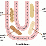 Cast formation in the renal tubules