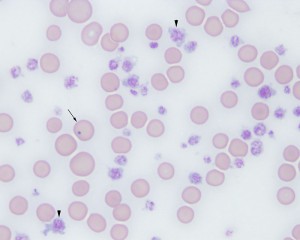 Thrombocytosis