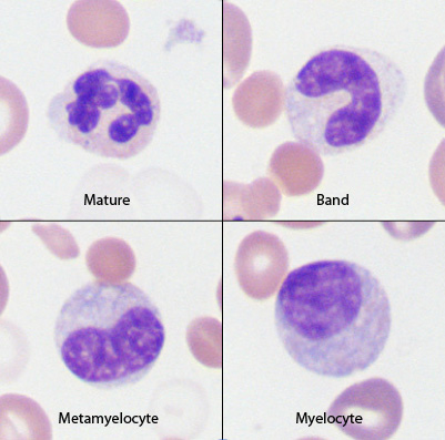 myelocyte and metamyelocyte