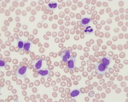 Chronic leukemia of granular lymphocytes in a dog | eClinpath