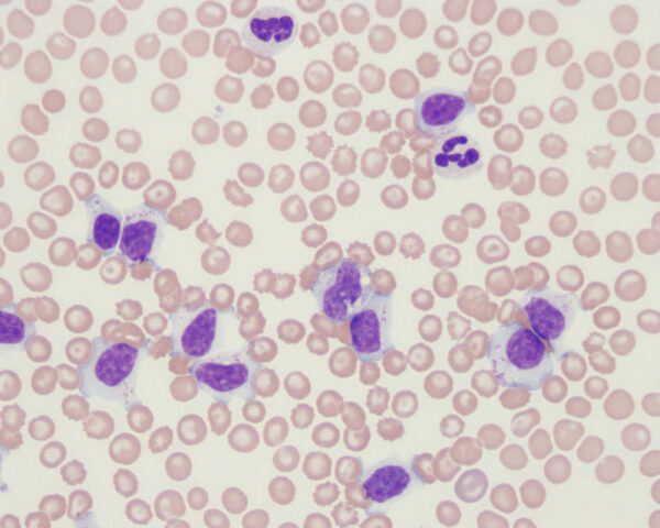 CLL-GL