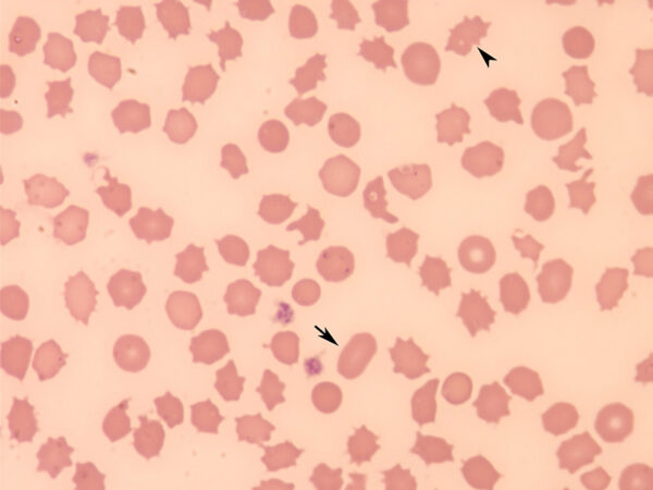 Poikilocytes