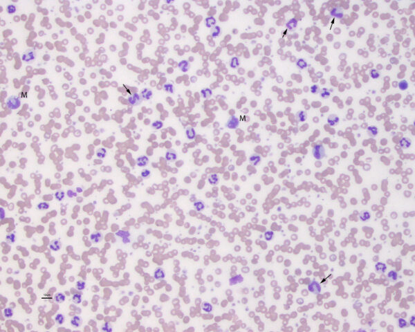 Leukocytosis