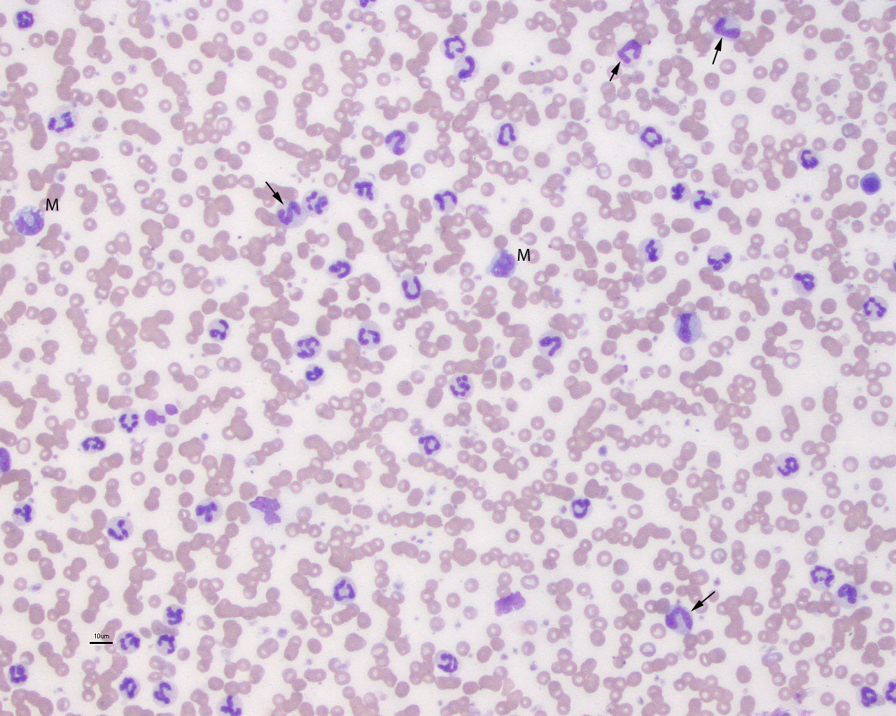 band neutrophil pathology