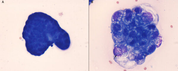 Mesos vs carcinoma