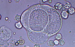 Neoplastic cell urine