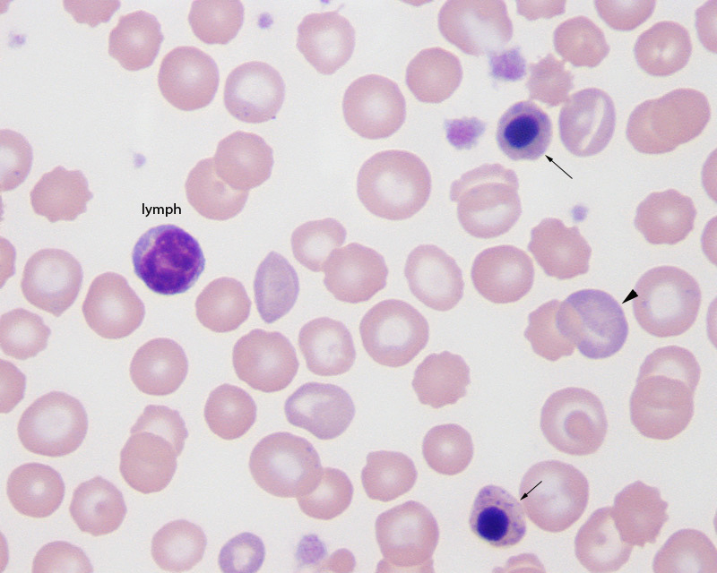 Nucleated RBC versus lymphocytes | eClinpath