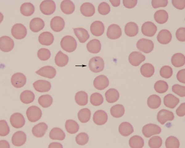 Siderocytes