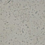 Keratinized and non-keratinized squamous cells in an urine sample