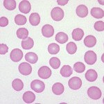 Blood smear from a dog with thrombocytopenia