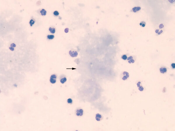 Bile peritonitis